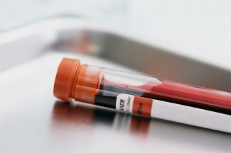 हाल ही में एक रक्त परीक्षण की भविष्यवाणी की गई ताकि आत्महत्या जोखिम बढ़े लेकिन क्या हम वास्तव में एक साधारण रक्त परीक्षण के साथ आत्महत्या जोखिम की भविष्यवाणी कर सकते हैं?