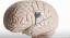 द्विध्रुवी अवसाद के लिए वागस तंत्रिका तंत्रिका उत्तेजना क्या है?